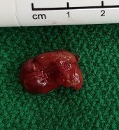 Nebenschilddrüsenadenom Nebenschilddrüsenadenom