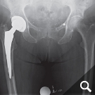 Infizierte Hüfttotalendoprothese Infizierte Hüfttotalendoprothese